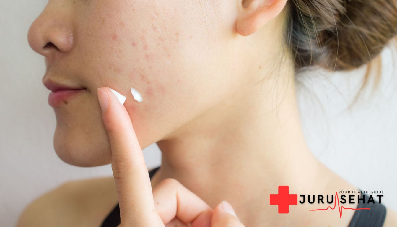 skincare untuk kulit berjerawat tips memilih produk yang tepat

