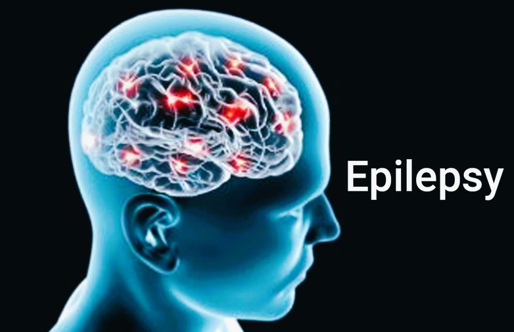 Penyakit Epilepsi : Gejala, Penyebab, dan Pengobatannya 