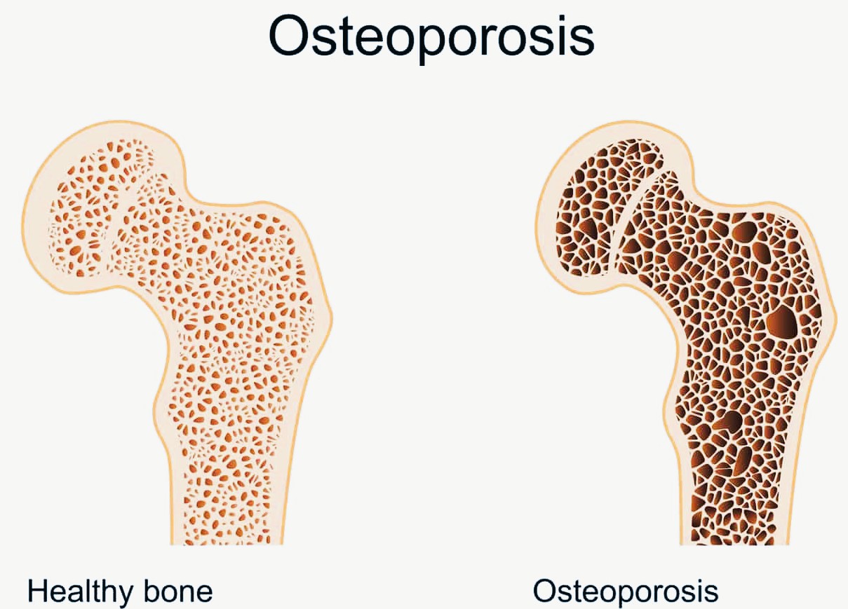 Osteoporosis : Penyebab, Gejala, Diagnosis dan Pengobatan