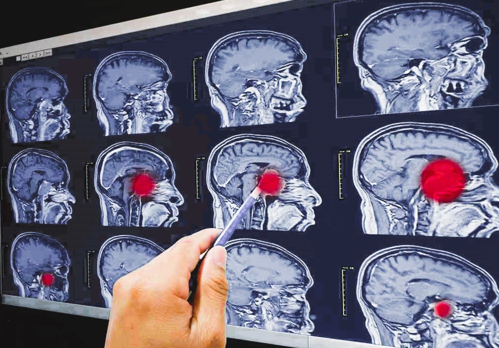 Abses Otak : Penyebab, Gejala, Diagnosis dan Pengobatan