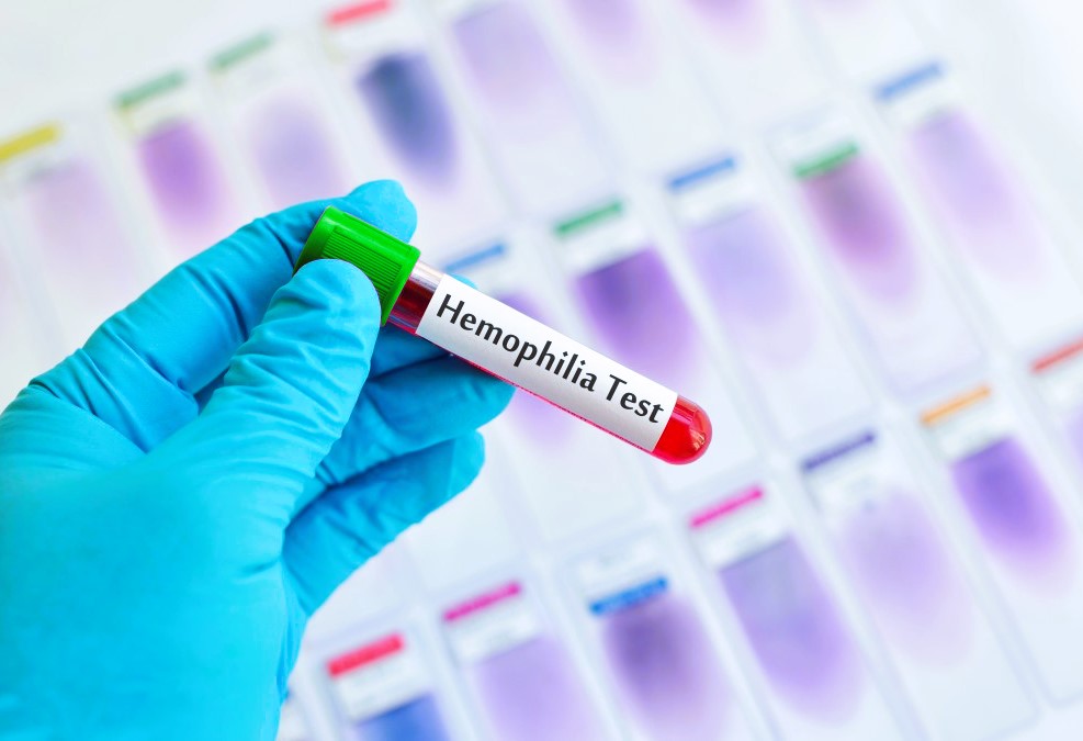 Penyakit Hemofilia : Gejala, Penyebab, Diagnosis dan Pengobatan