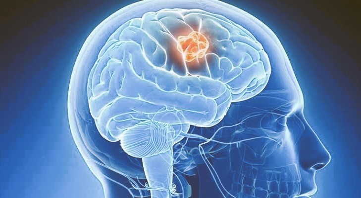 Abses Otak : Penyebab, Gejala, Diagnosis dan Pengobatan